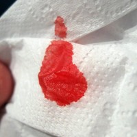 mendiagnosa-leukemia-pada-anak