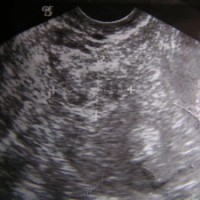 terapi-kelainan-janin-trimester-2