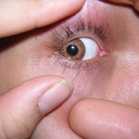 Mengatasi Sakit Mata Pada Anak