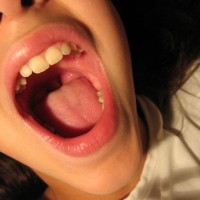 mengatasi gigi berlubang pada anak