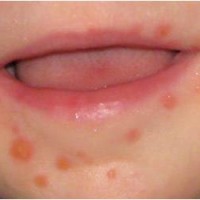 penyakit-kaki-tangan-mulut